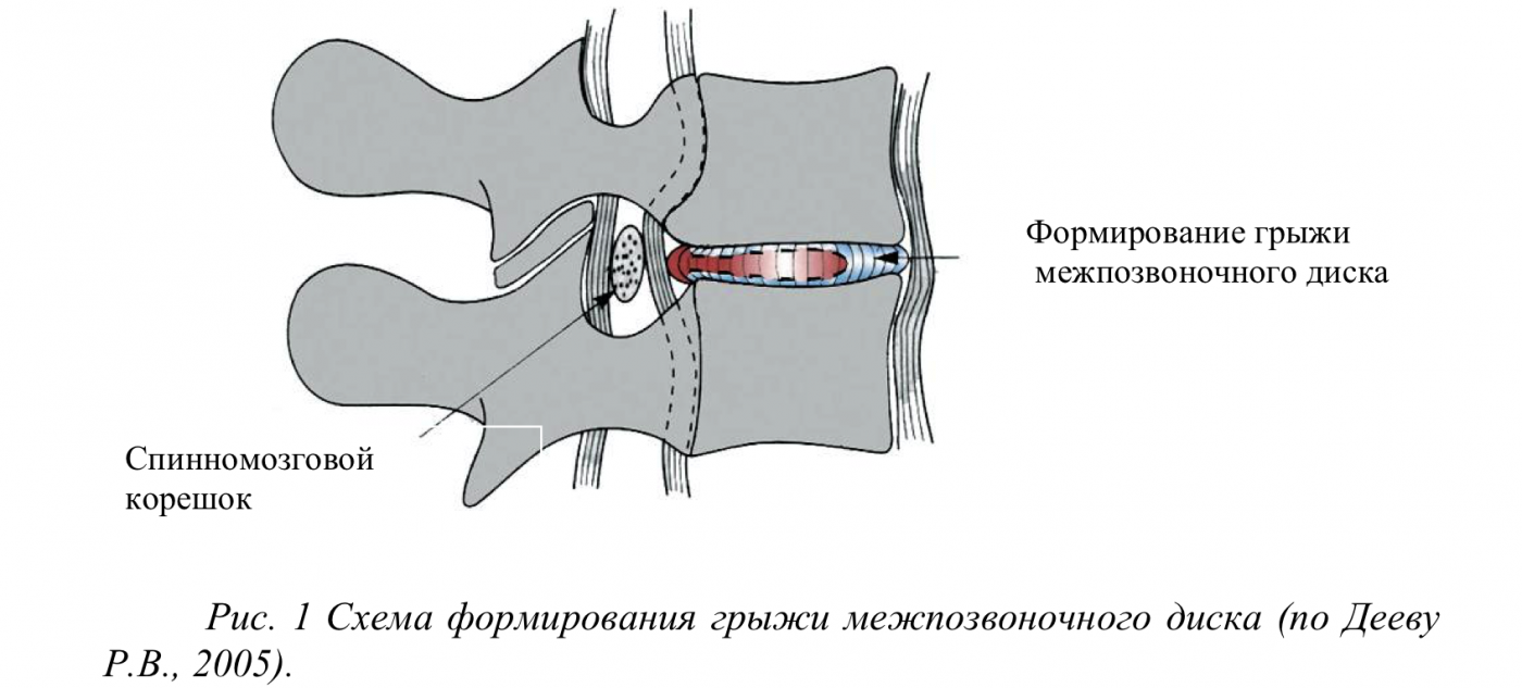 Эффективность комплексного лечения вертебрального болевого синдрома с  применением электрофореза с карипаином у больных остеохондрозом  пояснично-крестцового отдела позвоночника | Карипаин